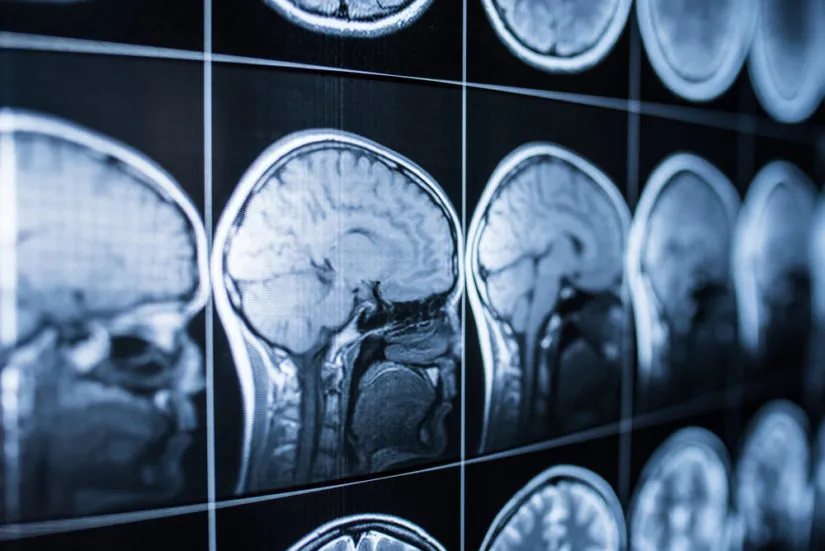 An MRI scan.